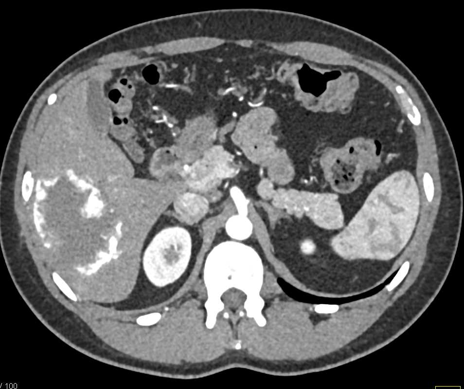 Hepatic Hemangioma - CTisus CT Scan