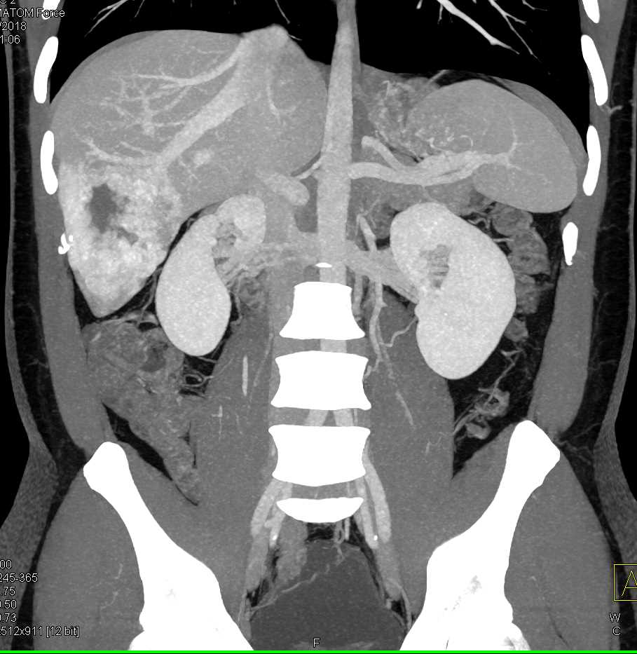 Hepatic Hemangioma - CTisus CT Scan