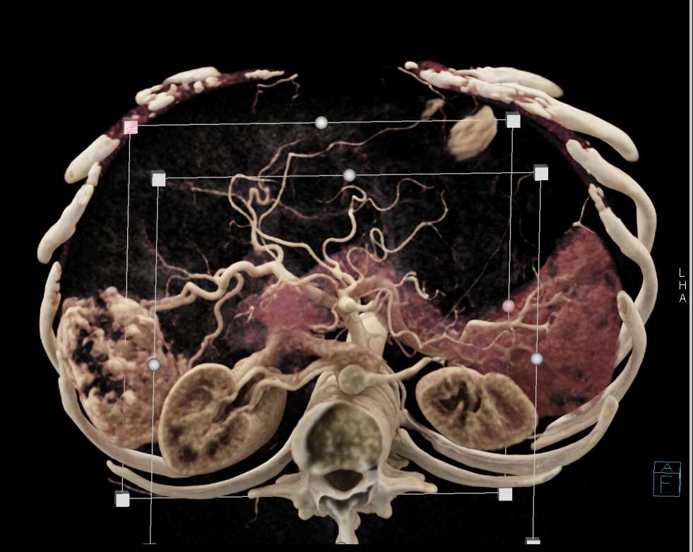 Hepatic Hemangioma - CTisus CT Scan