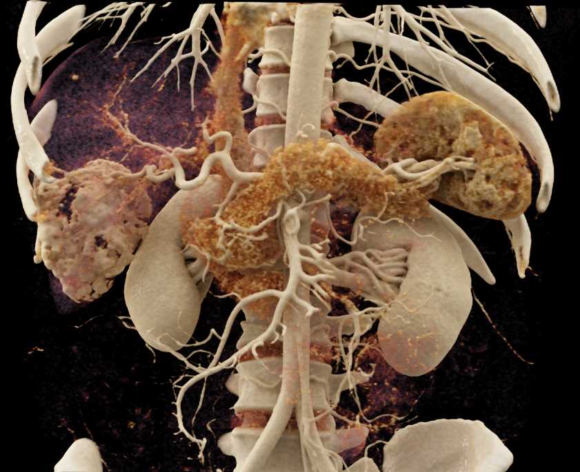 Hepatic Hemangioma - CTisus CT Scan
