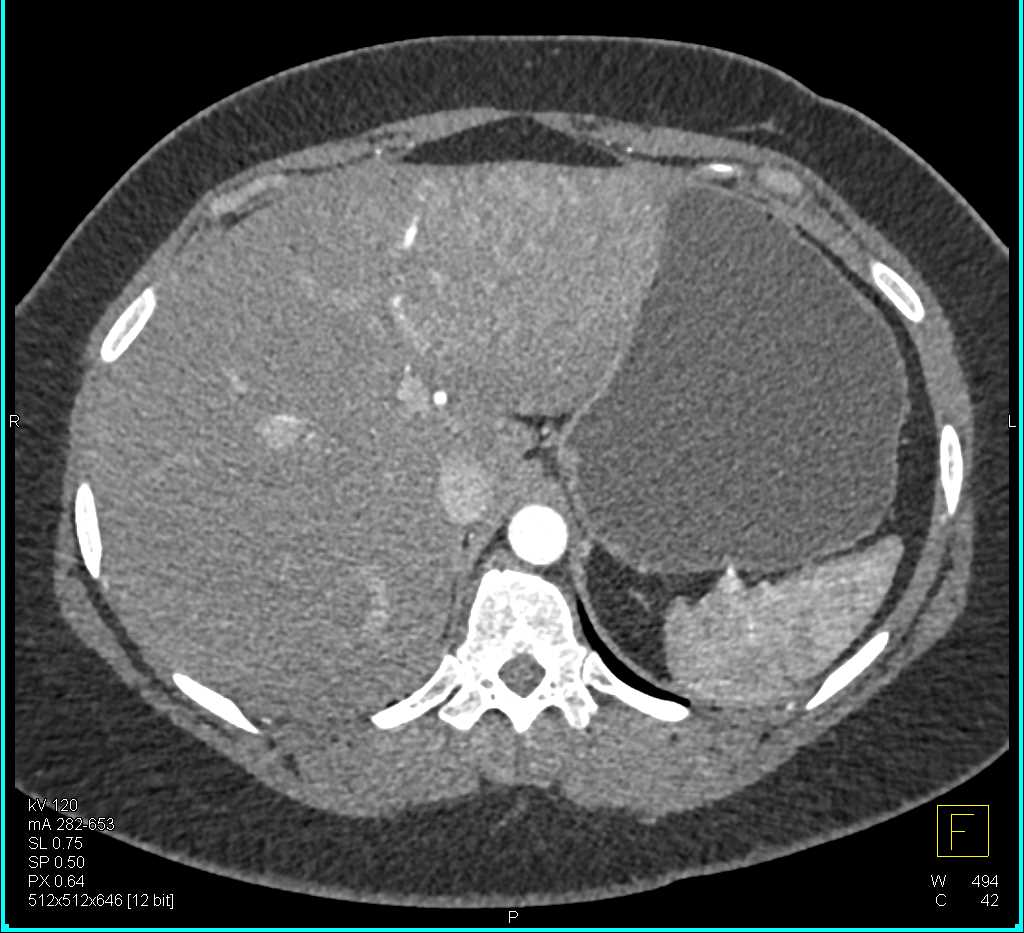 Hepatic Adenoma - CTisus CT Scan