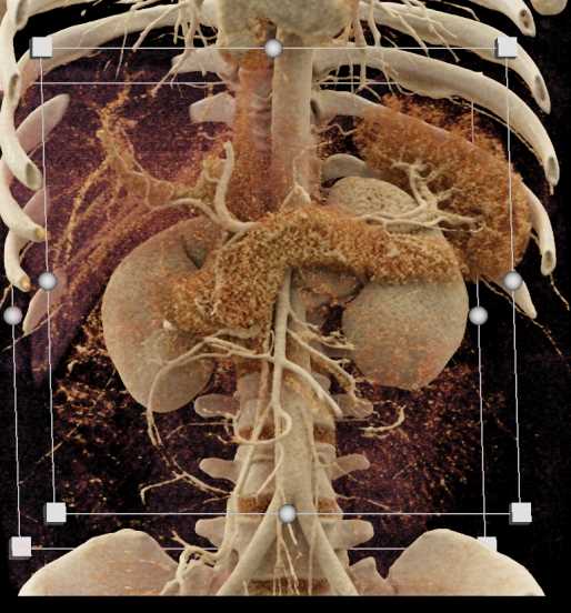 Hepatic Adenoma - CTisus CT Scan