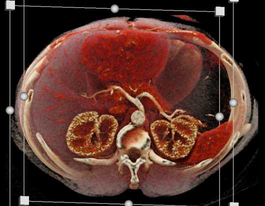 Hepatic Adenoma - CTisus CT Scan