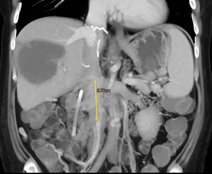 Cystic Metastases to the Liver - CTisus CT Scan