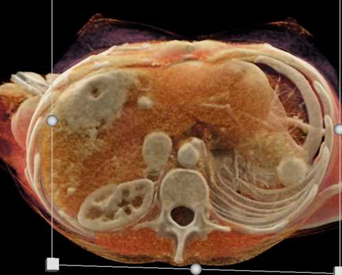 Multiple Vascular Liver Metastases - CTisus CT Scan