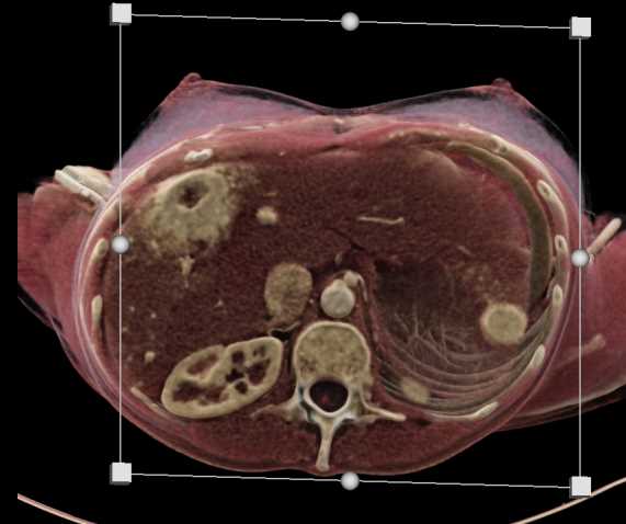 Multiple Vascular Liver Metastases - CTisus CT Scan