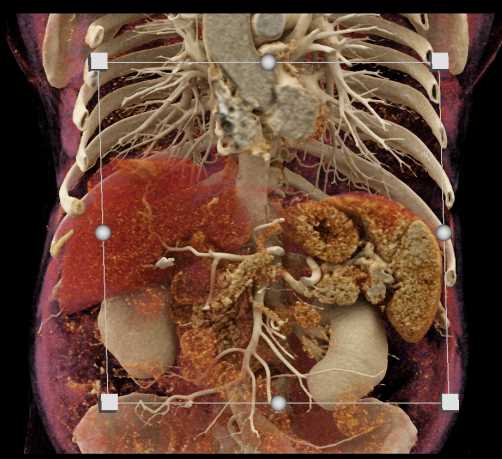 Vascular Mapping with Liver Metastases - CTisus CT Scan