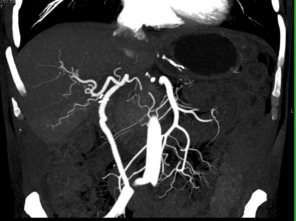 CTPV with Bypass Grafts - CTisus CT Scan