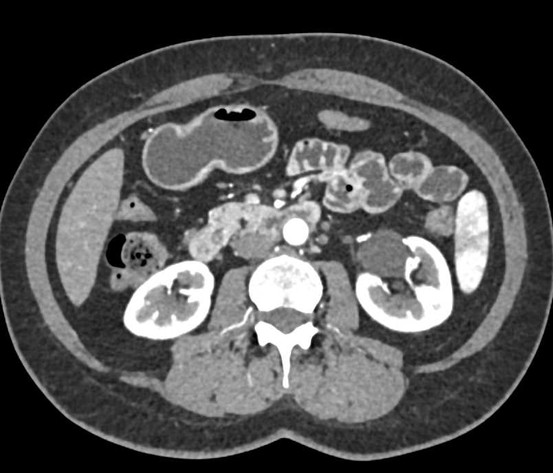 Dilated Common Bile Duct (CBD) Without a Mass - CTisus CT Scan