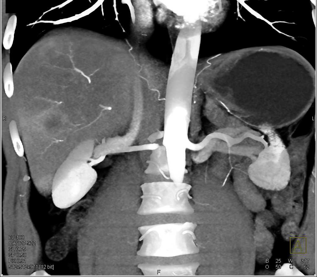 Vascular Liver Metastases - CTisus CT Scan