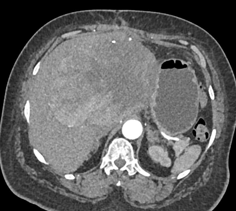 Cholangiocarcinoma Looking Like a Hepatocellular Carcinoma (Hepatoma) - CTisus CT Scan