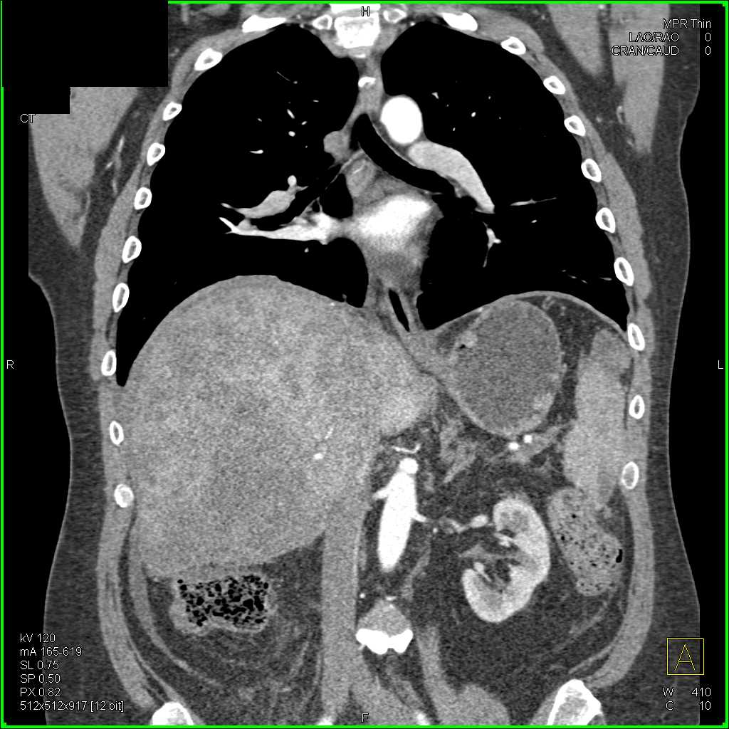 Incidental PE in Right Lower Lung in Patient with Hepatoma - CTisus CT Scan