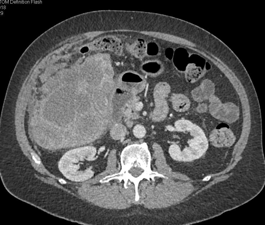 Incidental PE in Right Lower Lung in Patient with Hepatoma - CTisus CT Scan