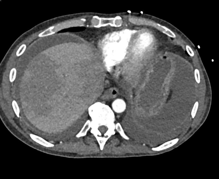 CTisus CT Scanning | Focal Fatty Liver