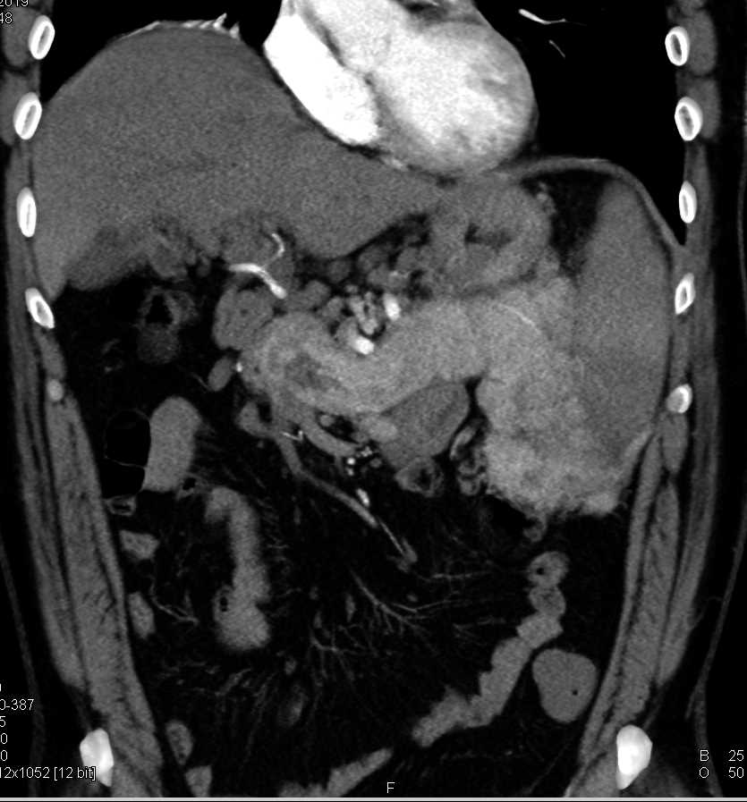 Cirrhosis with Portal Hypertension and Varices - CTisus CT Scan