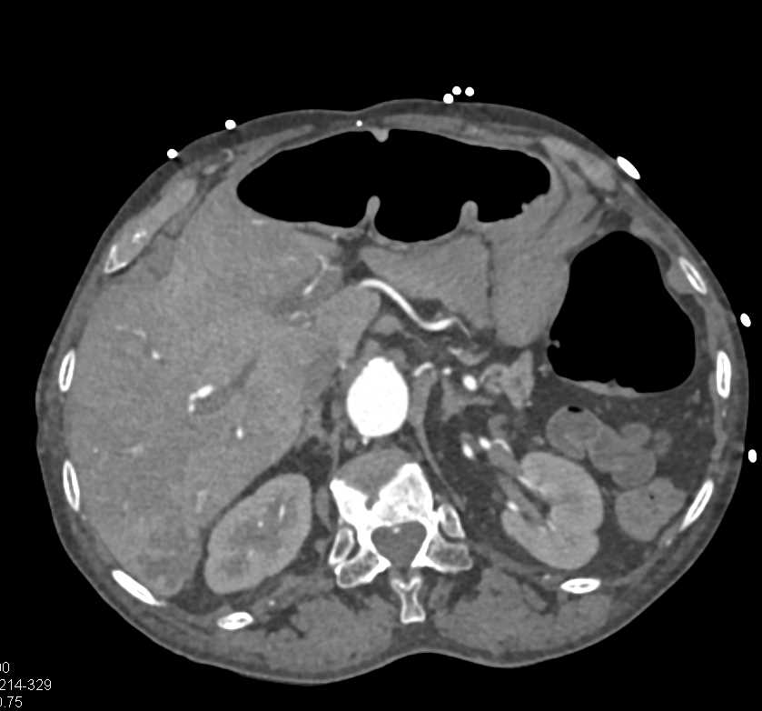 Hemangioma Right Lobe Liver - CTisus CT Scan