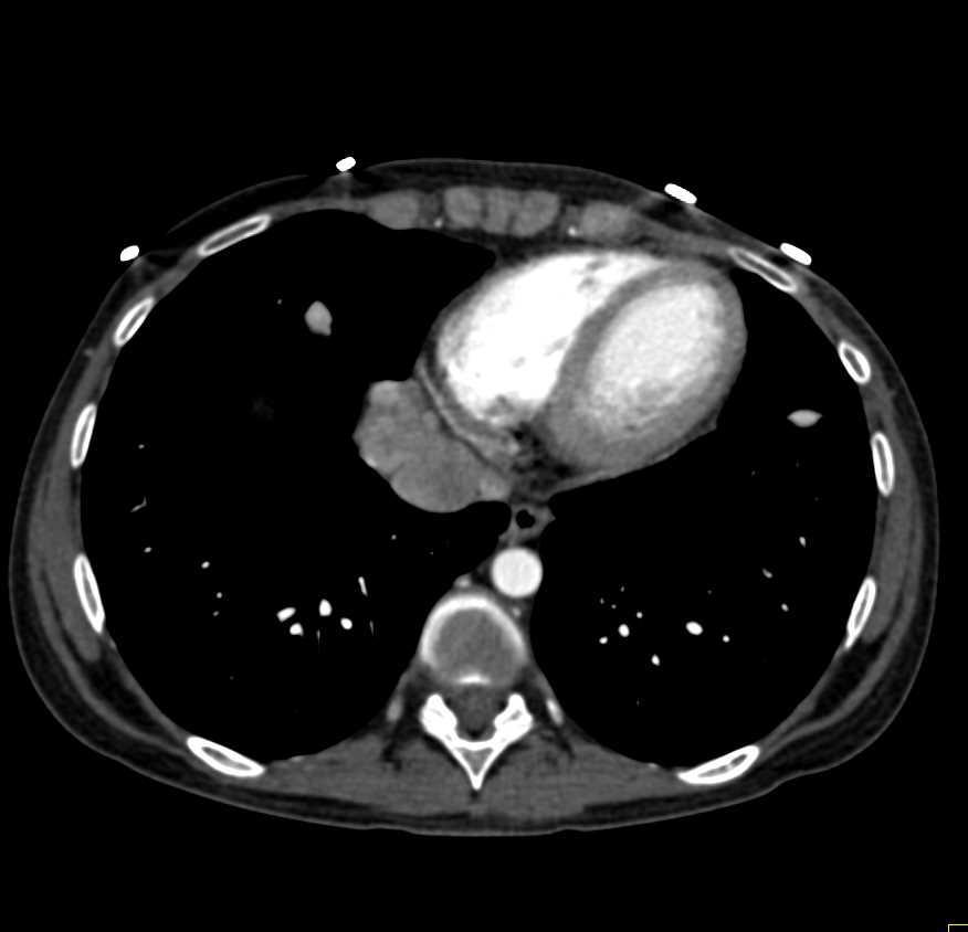 Fibrolamellar Hepatocellular Carcinoma (Hepatoma) with Lung Metastases - CTisus CT Scan