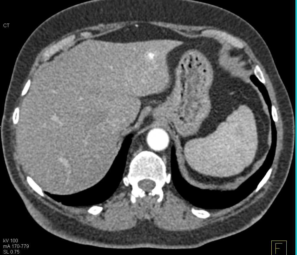 Flash Filling Hemangioma Left Lobe of Liver - CTisus CT Scan