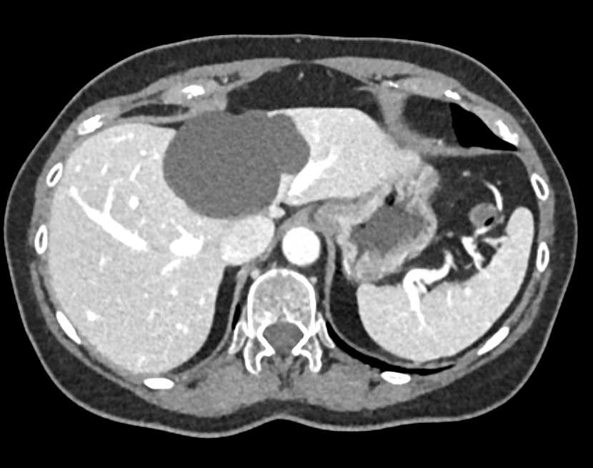 Simple Liver Cyst - CTisus CT Scan