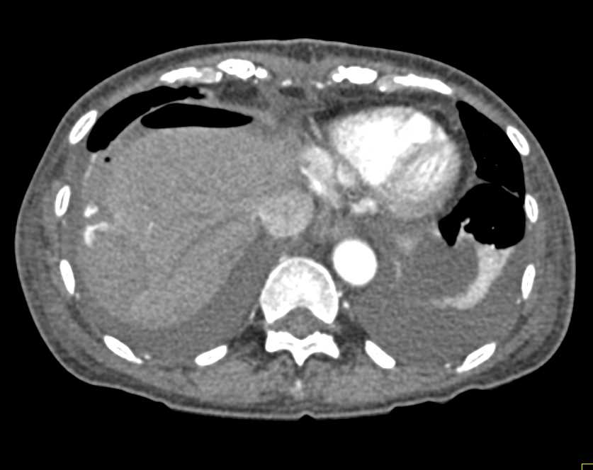 Bleed Post Hepatic Resection - CTisus CT Scan