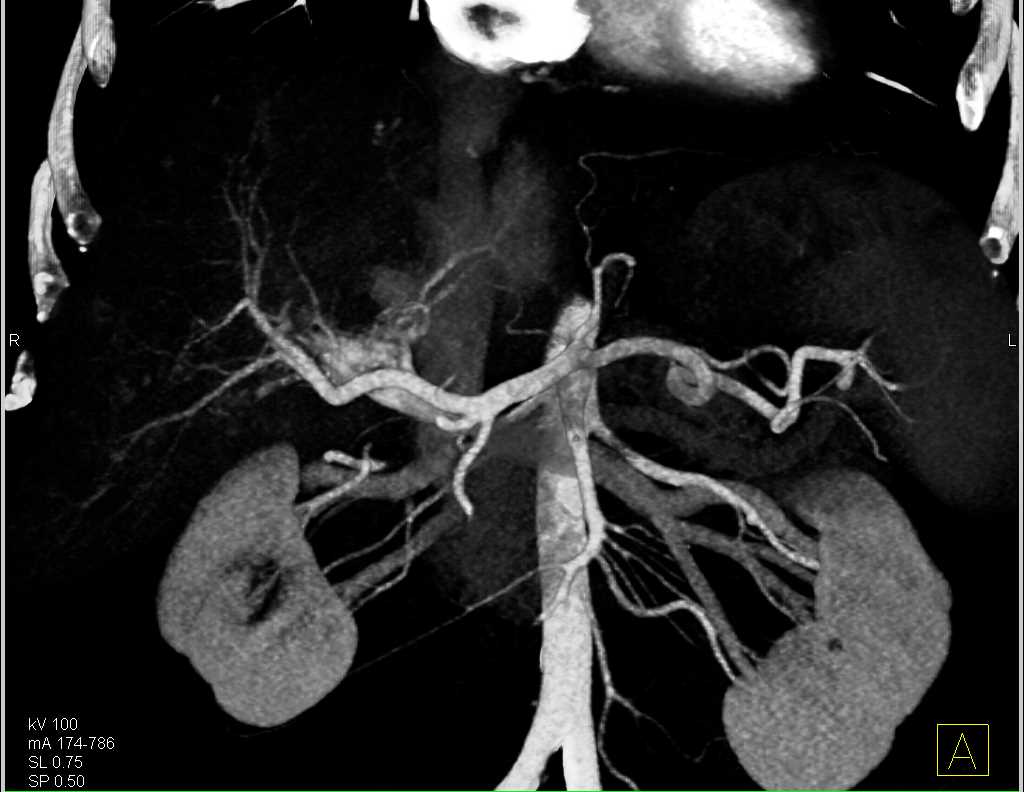 Hepatoma with Poral Vein Thrombosis - CTisus CT Scan