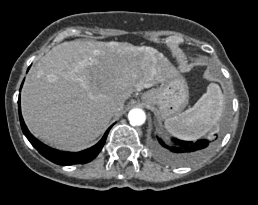 Multifocal Hepatoma - CTisus CT Scan