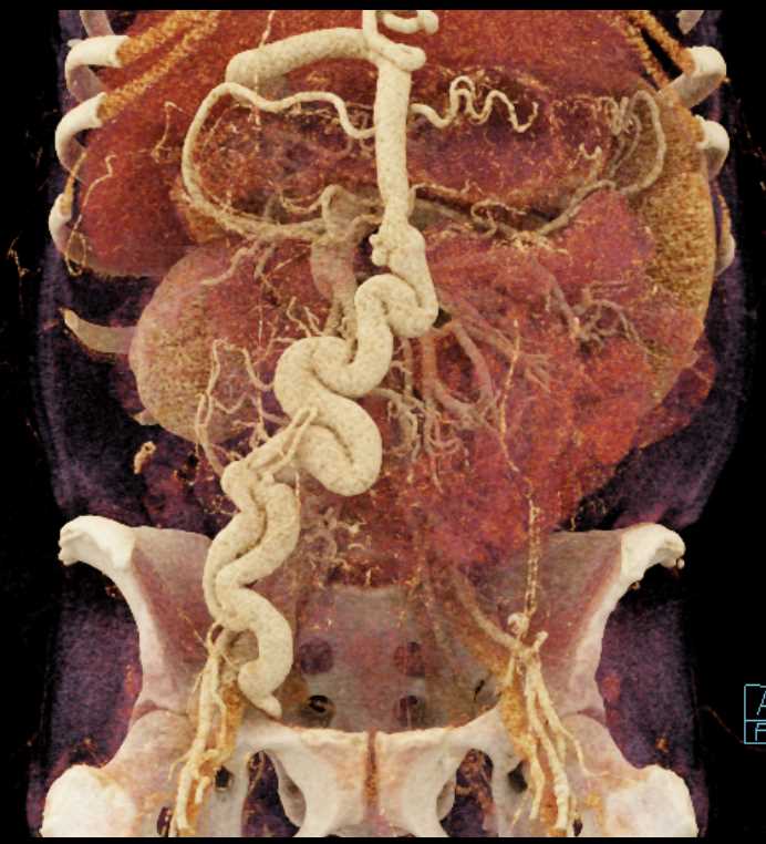 Cirrhosis with Large Varices - CTisus CT Scan