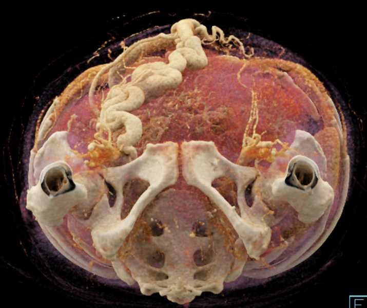 Cirrhosis with Large Varices - CTisus CT Scan