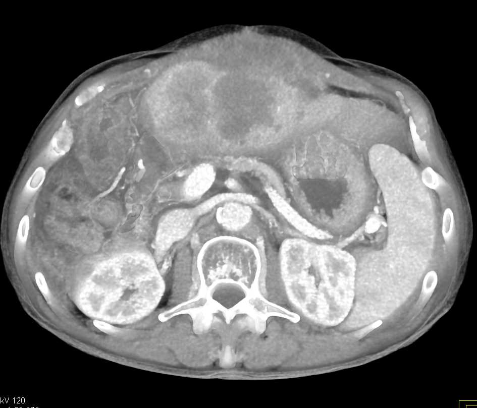 Hepatoma Extends Beyond Capsule - CTisus CT Scan