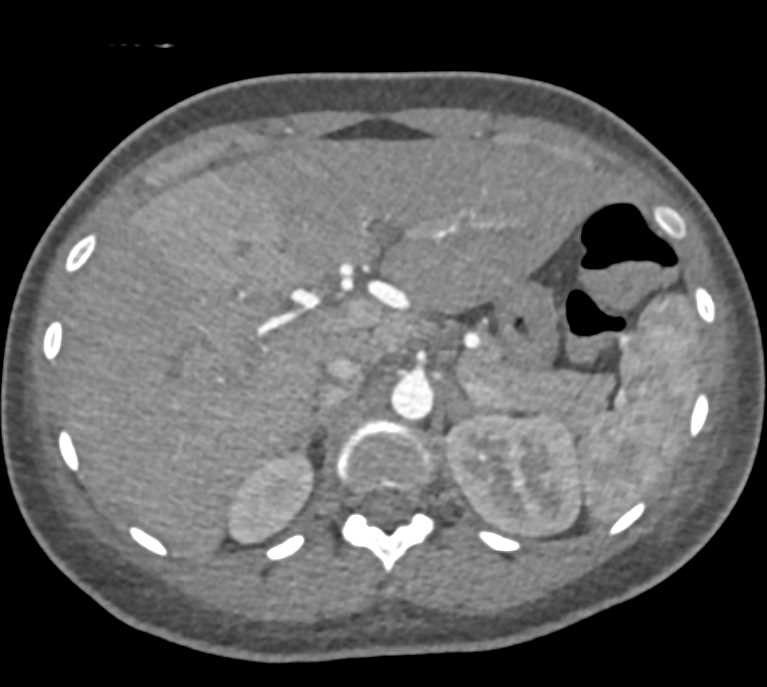 Liver Abscess due to Klebsiella - CTisus CT Scan