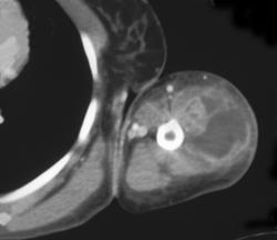 Intramuscular Abscess - CTisus CT Scan