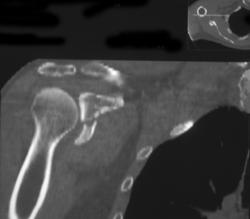 Scapular Fracture - CTisus CT Scan