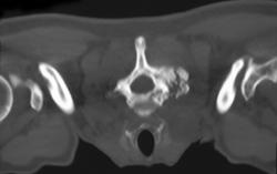 Metastases to Spine From Renal Cell Cancer - CTisus CT Scan