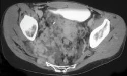 Neurofibromatosis - CTisus CT Scan