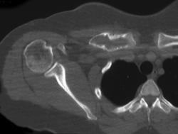 Cystic Changes Right Clavicle Due to Prior Trauma - CTisus CT Scan