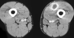 Intramuscular Abscess - CTisus CT Scan