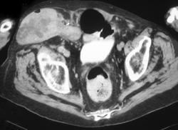 Leiomyosarcoma - CTisus CT Scan