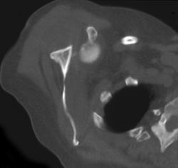 Fracture Dislocation of the Shoulder - CTisus CT Scan