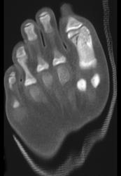 Fracture 1st Digit - CTisus CT Scan