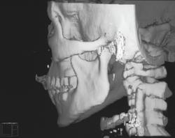 3D Shaded Surface Reconstruction of the Face - CTisus CT Scan