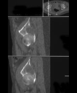 Metastatic Renal Cell Carcinoma - CTisus CT Scan