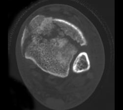 Plafond Fracture - CTisus CT Scan