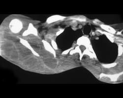 Intramuscular Abscess - CTisus CT Scan