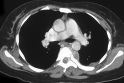 Metastasis to the Spine - CTisus CT Scan