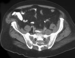 Neurofibromatosis - CTisus CT Scan