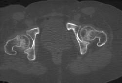 Femoral Neck Fracture - CTisus CT Scan