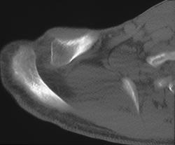 Widened Ac Joint - CTisus CT Scan