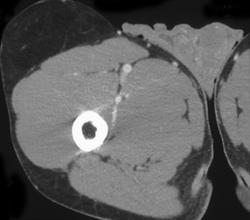 Lipoma Thigh - CTisus CT Scan