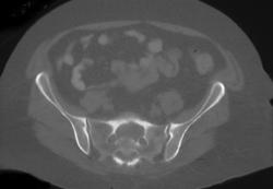 Metastatic Disease to Sacrum - CTisus CT Scan