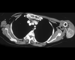 Metastases to Muscle From Renal Cell Cancer - CTisus CT Scan